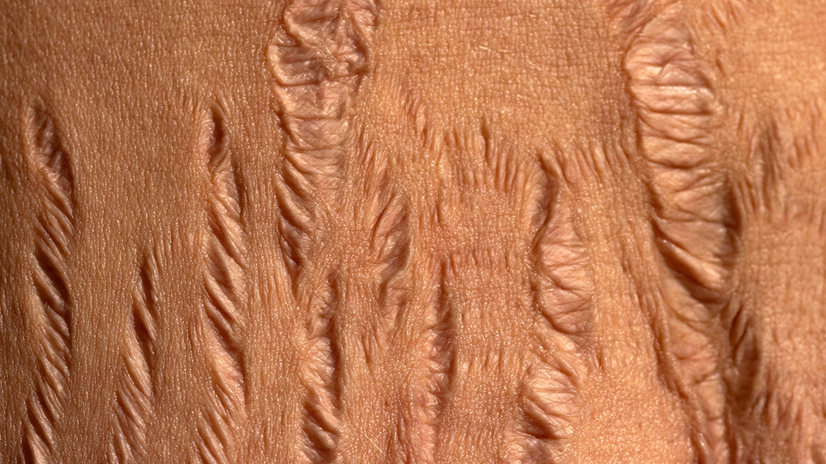 Stretch marks closeup on old skin